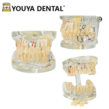 Dintii Modelul de Predare pentru Adulți Patologice Model cu Implant pentru Dentist Student care Studiază Comunicare Medic-pacient Instrumente