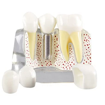 Dinții Model Demonstrativ Implant Detașabil Analiza Coroana Punte De Comunicare Cu Pacientul